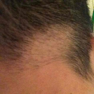 Causes of seborrheic alopecia?