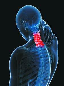 What are the symptoms of cervical spondylosis?