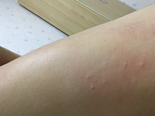 Can urticaria heal itself without treatment