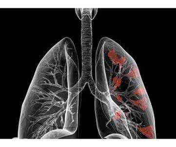 What are the symptoms of lung deficiency asthma?