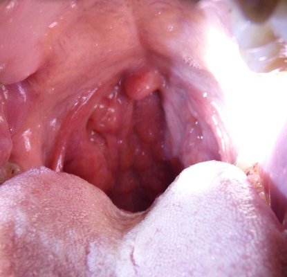 What are the acute symptoms of laryngitis?